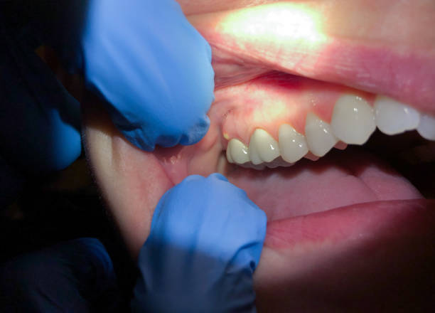 Best Emergency Treatment for Dental Infections or Abscesses in Key Biscayne, FL